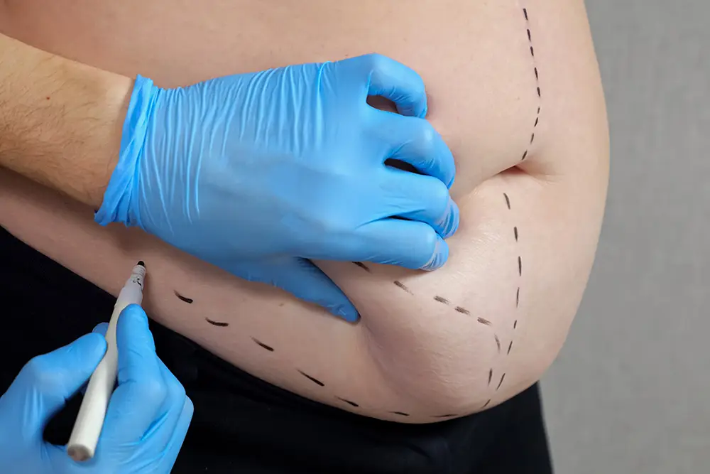 Liposuction